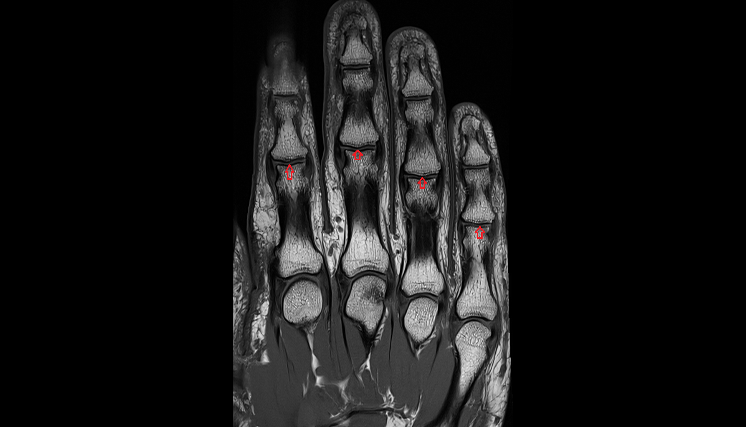 Proximal interphalangeal joints coronal cross sectional anatomy 3T MRI AI enhanced radiology image-img-00000-00000