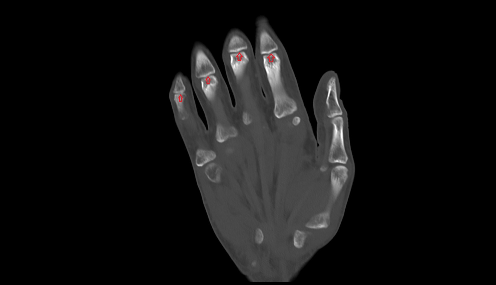 Proximal interphalangeal joints coronal ct image