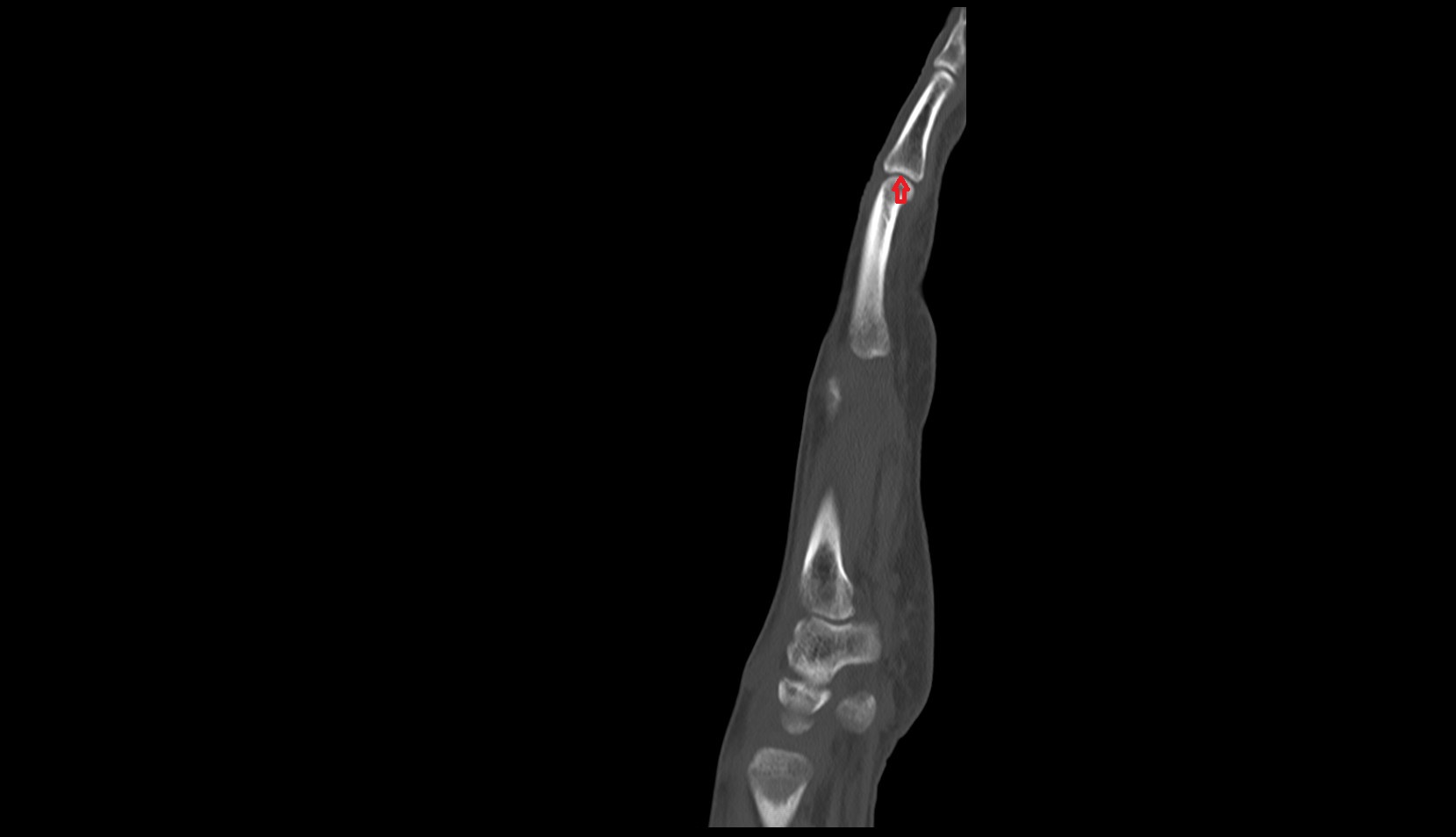 Proximal interphalangeal joints ct sagittal image