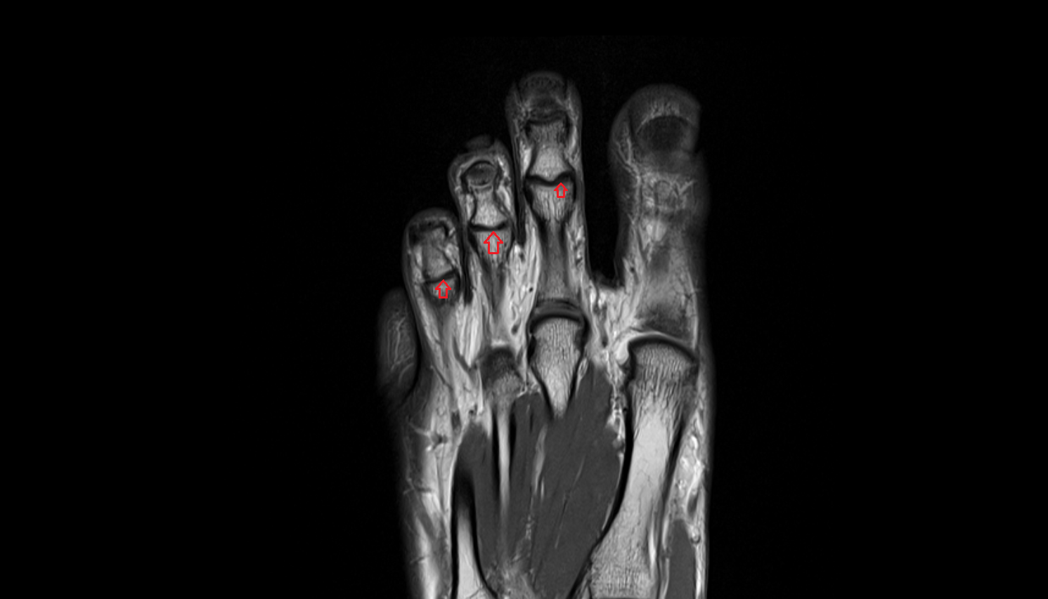 Proximal interphalangeal joints  of foot coronal cross sectional anatomy 3T MRI AI enhanced radiology image-img-00000-00000