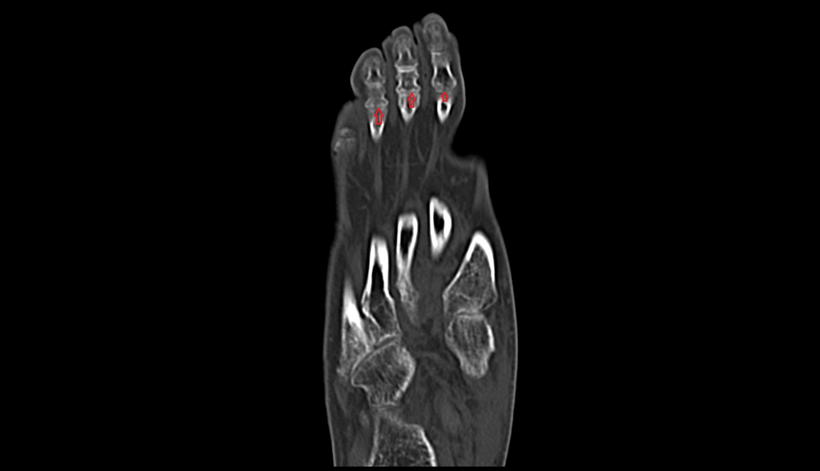 Proximal interphalangeal joints of foot ct coronal