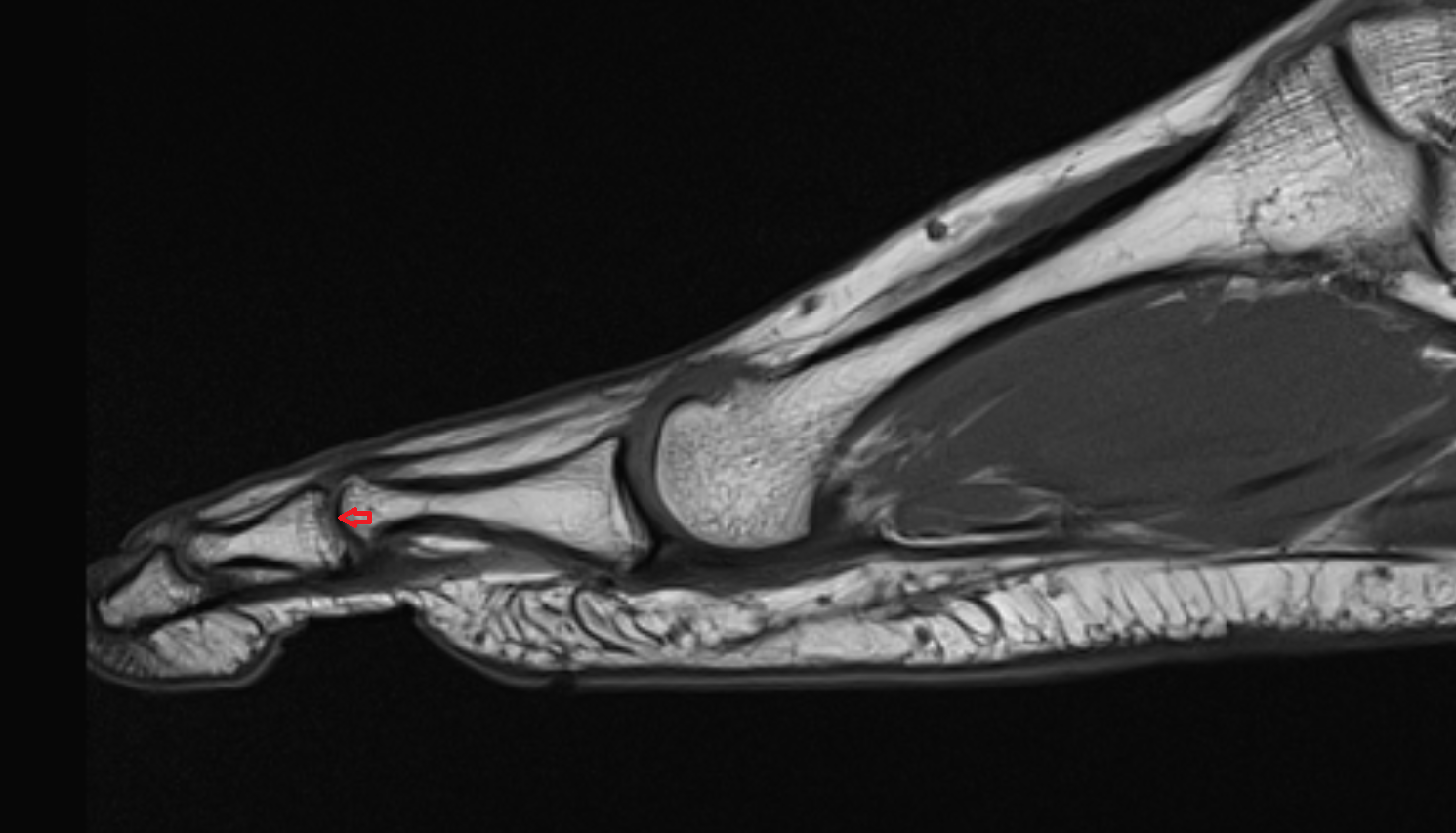 Proximal interphalangeal joints  of foot sag cross sectional anatomy 3T MRI AI enhanced radiology image-img-00000-00000