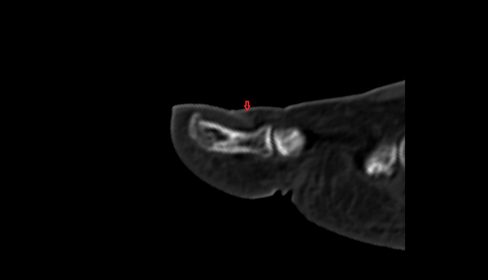Proximal nail fold ct sag