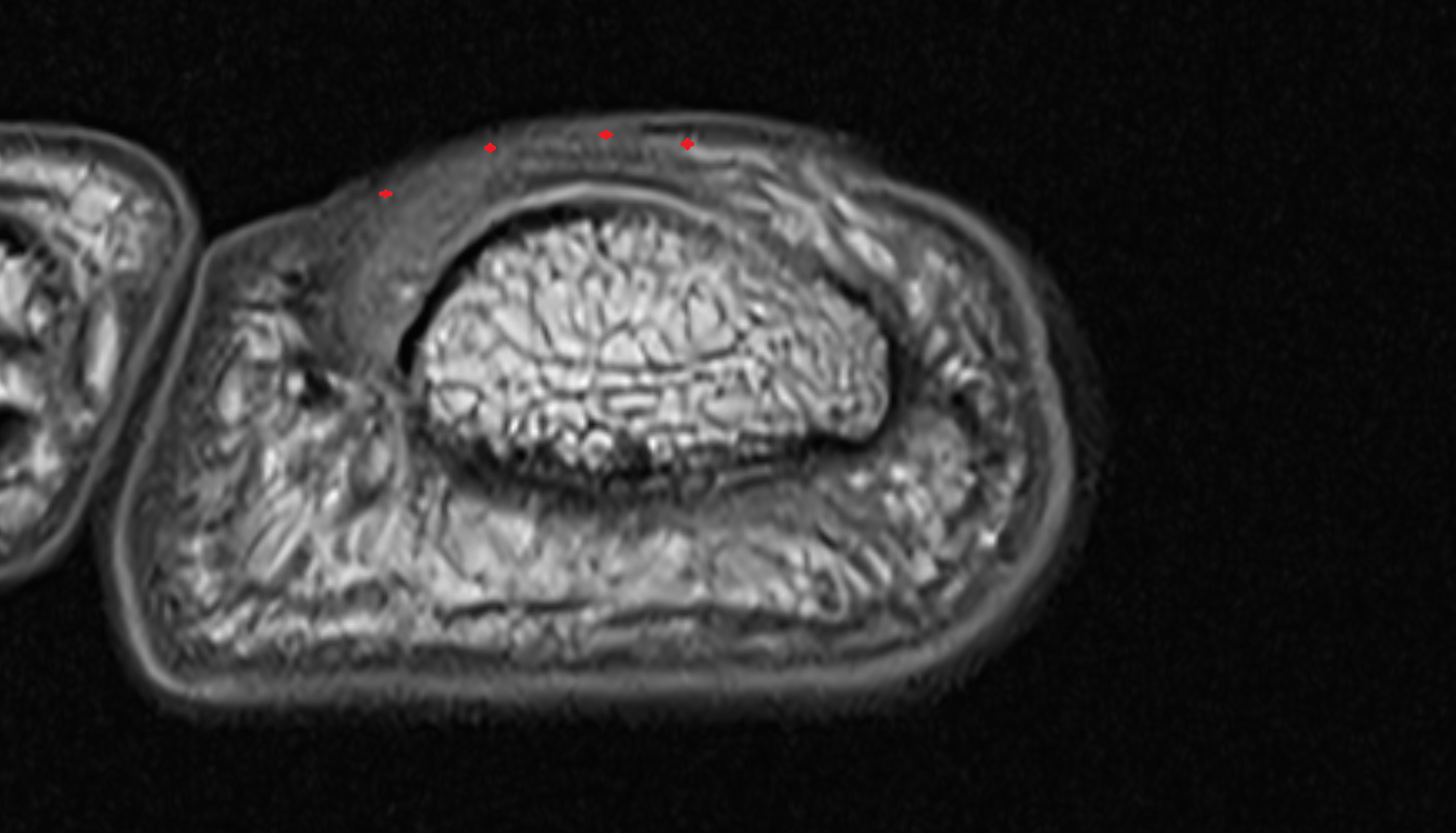 Proximal nail fold of toe axial cross sectional anatomy 3T MRI AI enhanced radiology image-img-00000-00000