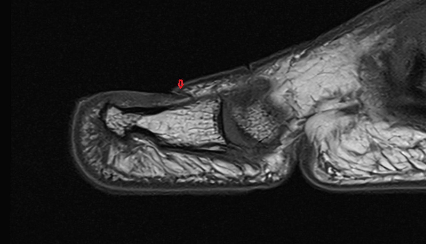 Proximal nail fold of toe sag cross sectional anatomy 3T MRI AI enhanced radiology image-img-00000-00000