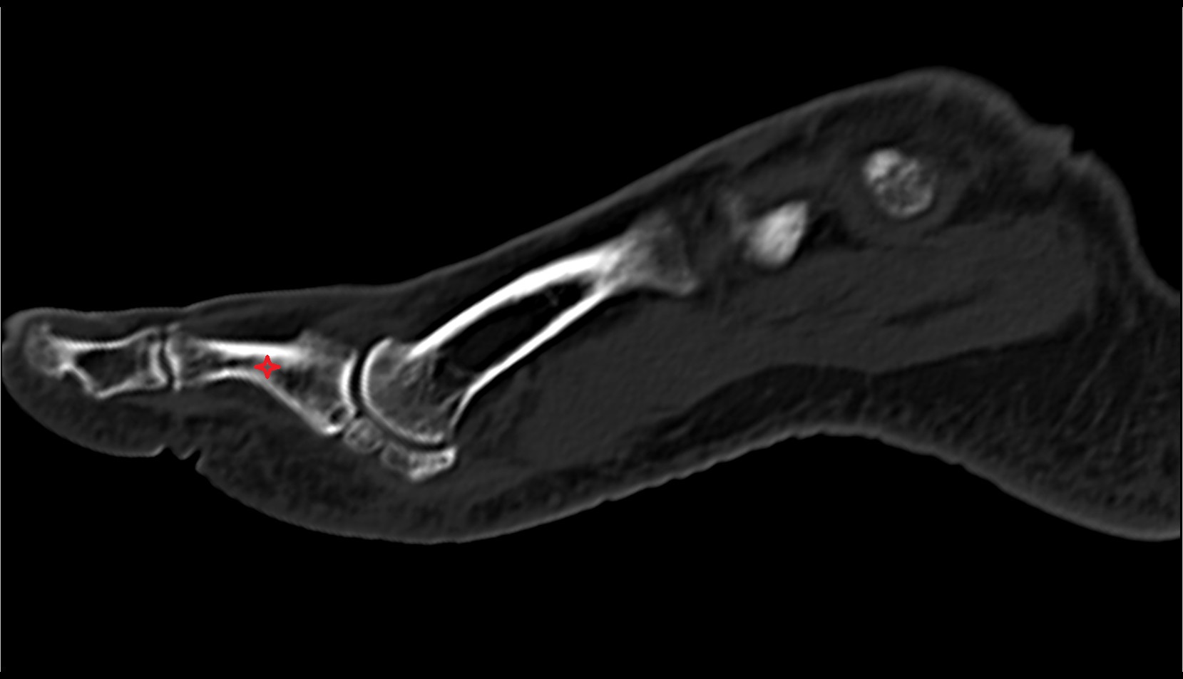 Proximal phalanx of great toe CT sagittal image