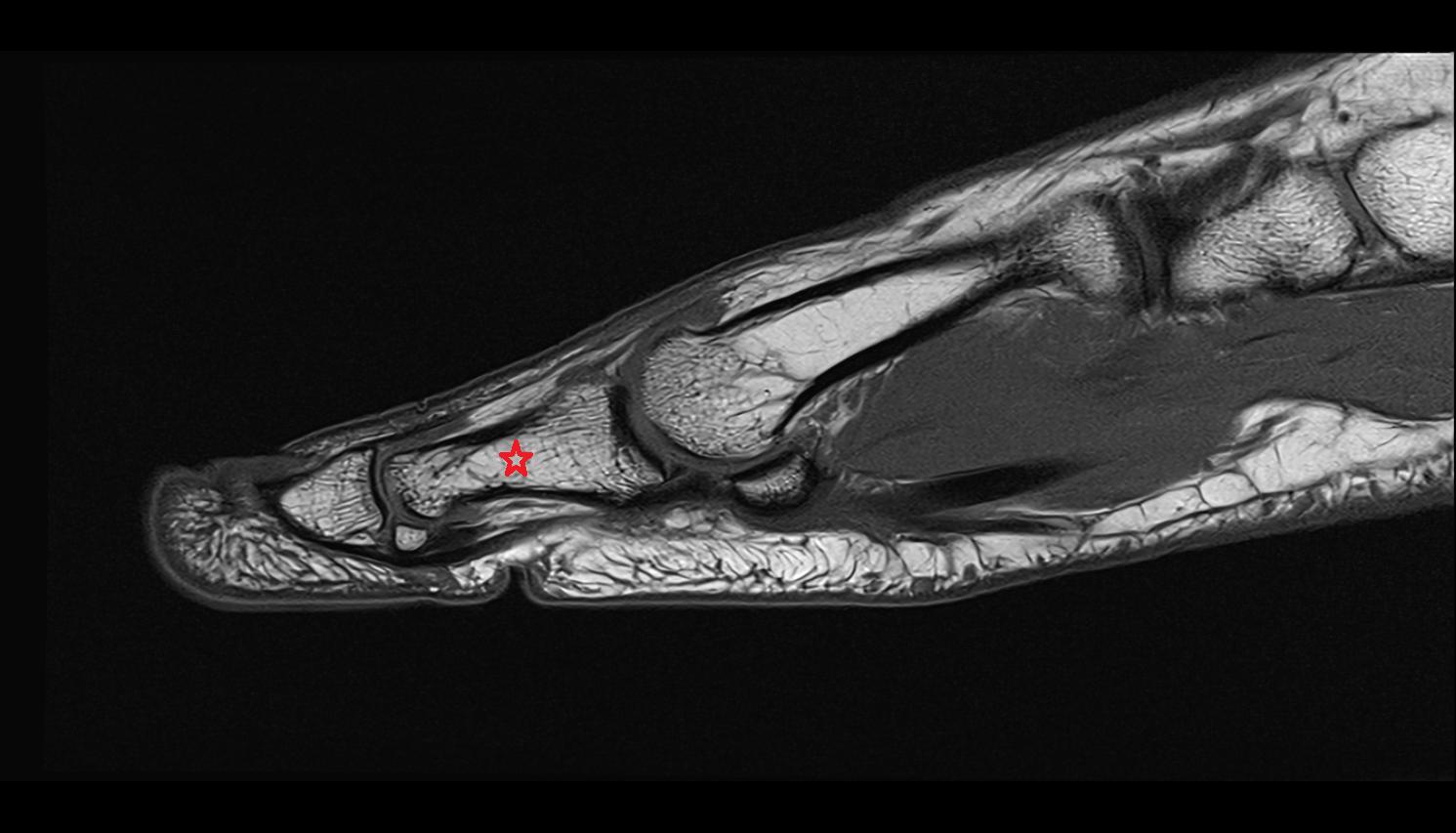 Proximal phalanx of great toe foot sagittal cross sectional anatomy 3T MRI AI enhanced radiology image-img-00000-00000