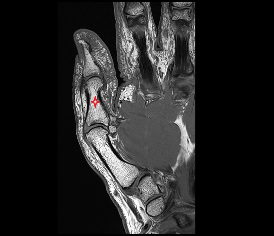 Proximal phalanx of thumb MRI IMAGE