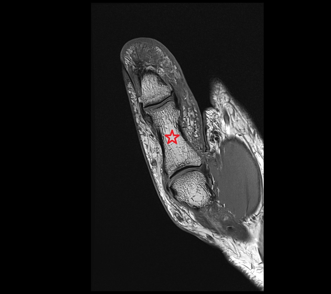 Proximal phalanx of thumb MRI coronal
