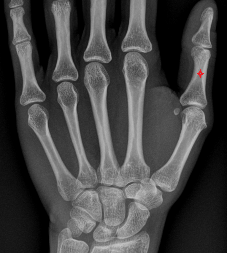 Proximal phalanx of thumb  x ray  anatomy labelled image-img-00000-00000