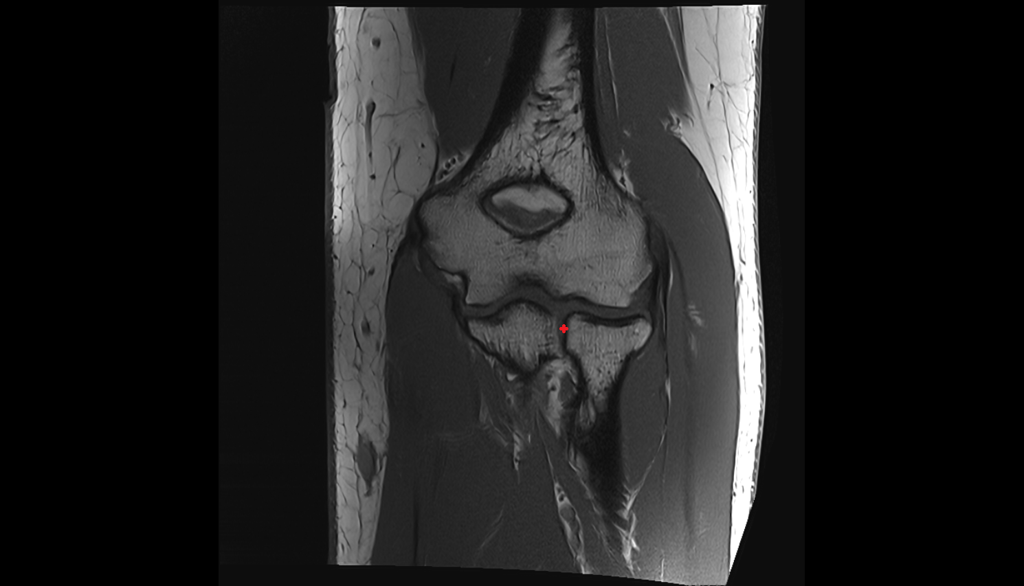 Proximal radioulnar joint coronal  cross sectional anatomy 3T MRI AI enhanced radiology image -img-00000-00000