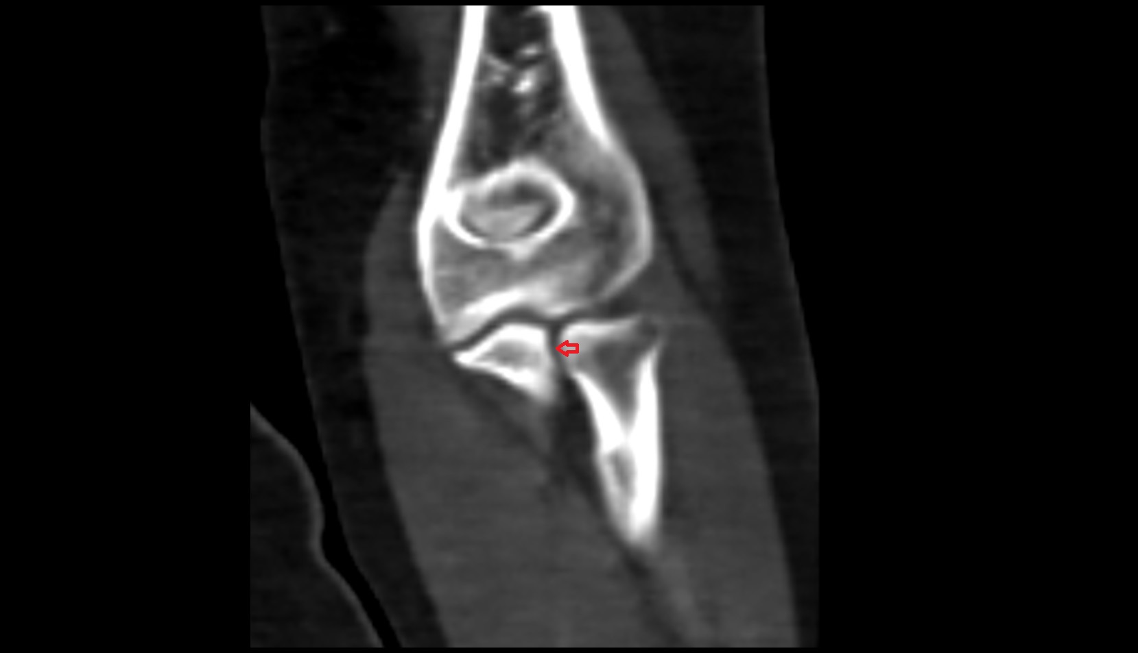 Proximal radioulnar joint ct joint