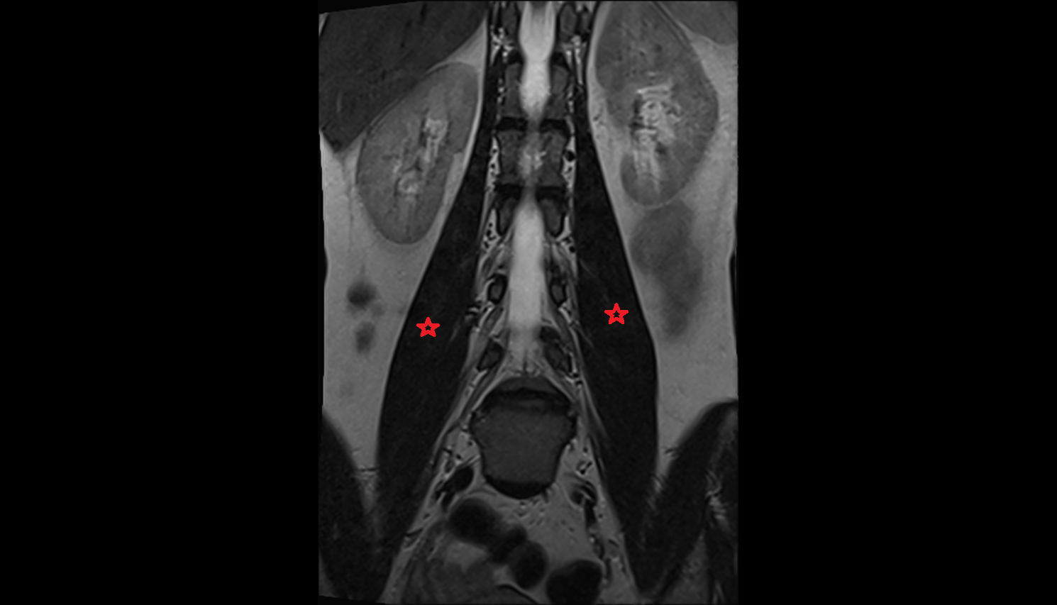 Psoas major  MRI  sagittal  image-img-00000-00000
