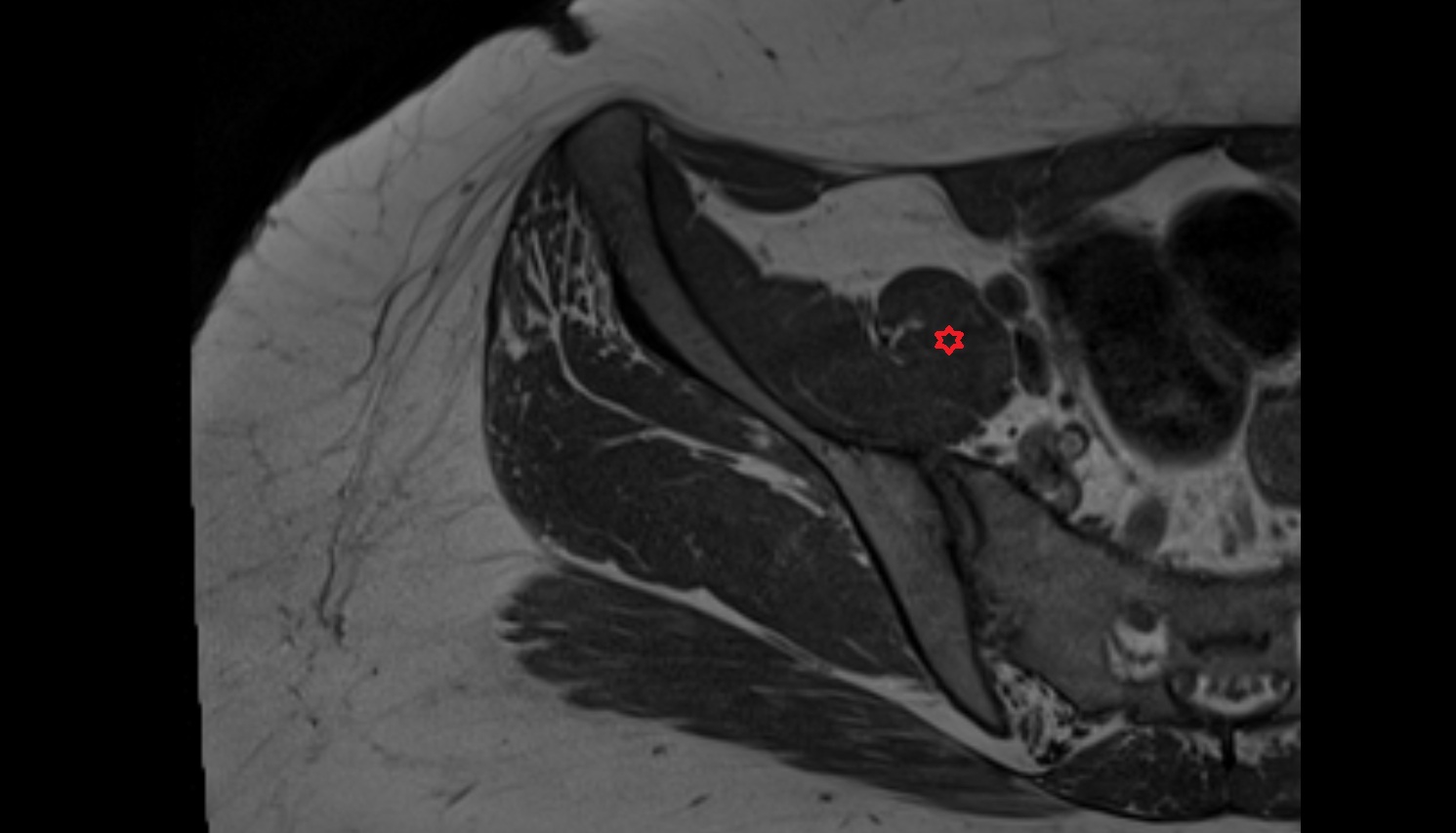 Psoas major muscle MRI  axial  anatomy  image-img-00000-00000