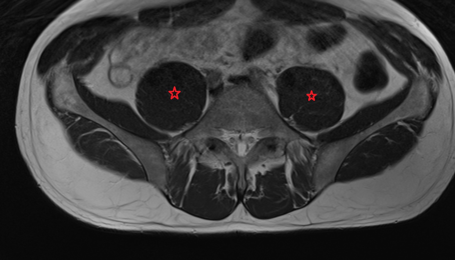 Psoas major muscle  MRI axial image anatomy  image -img-00000-00000