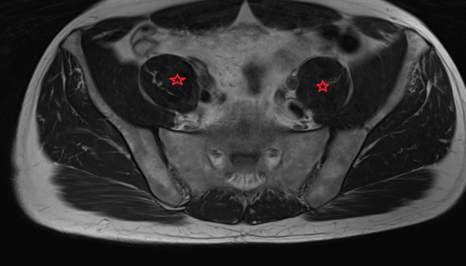 Psoas major muscle  MRI axial image anatomy  image -img-00000-00000_00001