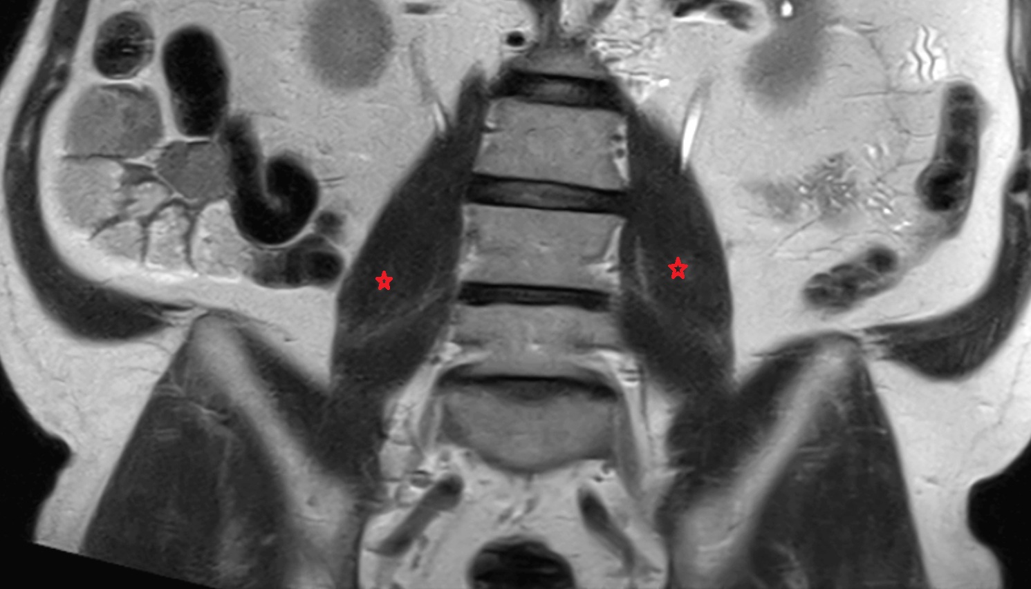 Psoas major muscle  MRI coronal  image anatomy  image -img-00000-00000