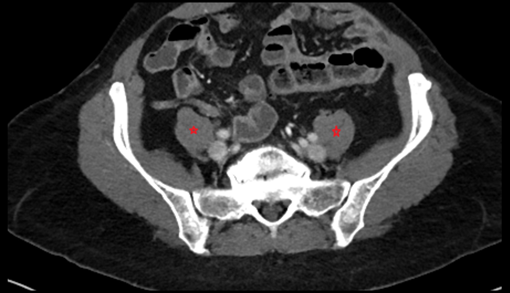 Psoas major muscle ct axial