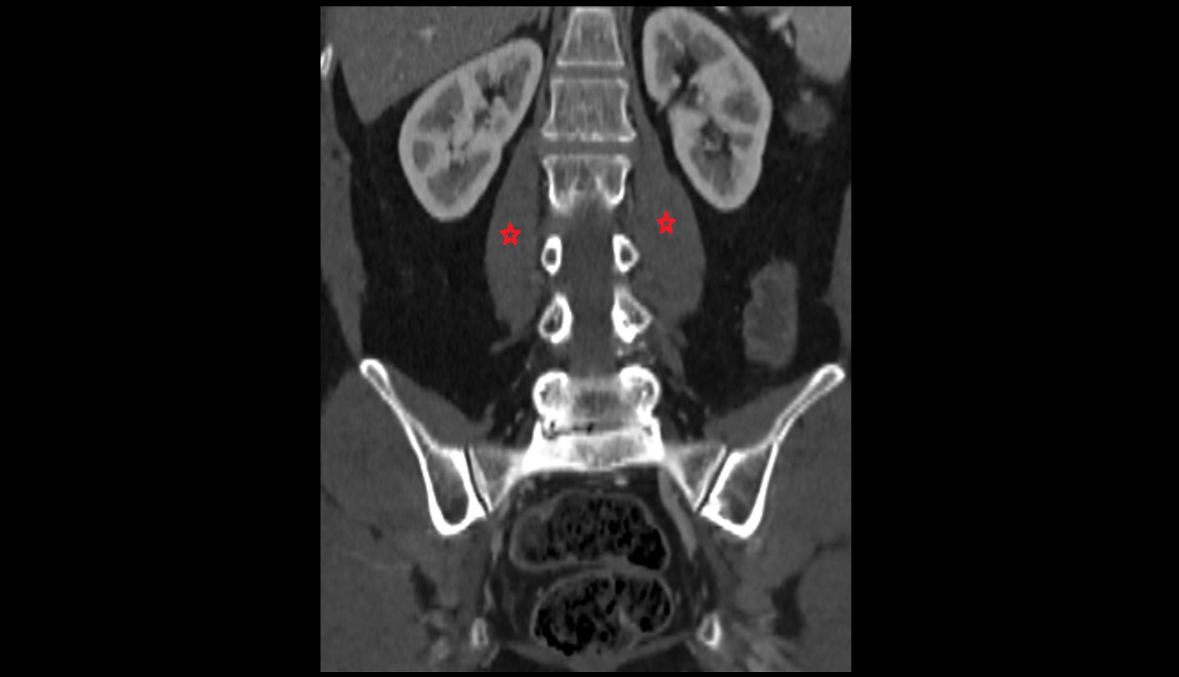 Psoas major muscle ct coronal