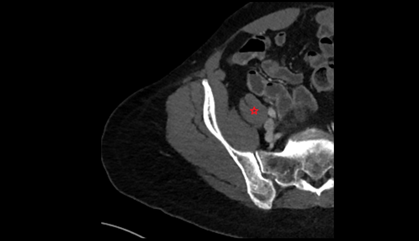 Psoas major muscle ct sfov axial