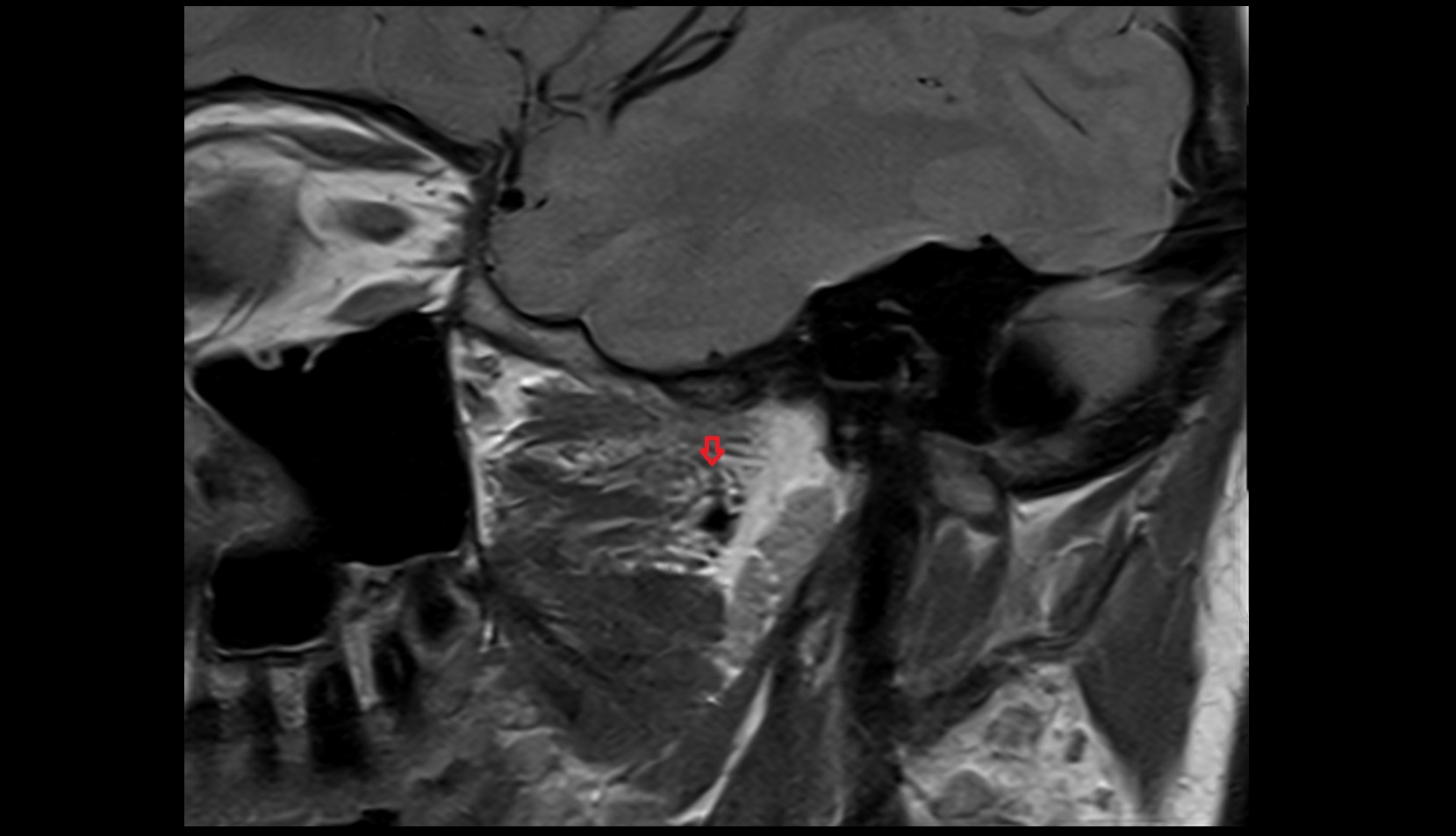 Pterygoid venous plexus MRI image