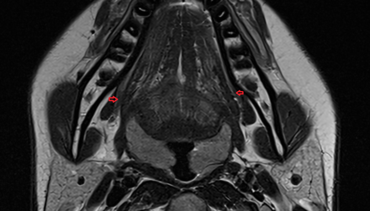 Pterygomandibular Raphe mri axial image -img-00000-00000