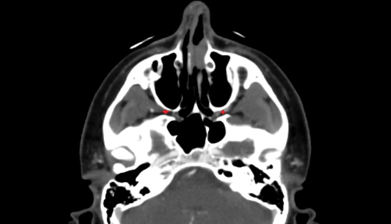 Pterygomaxillary fissure sinus CT  anatomy labelled image-img-00000-00000