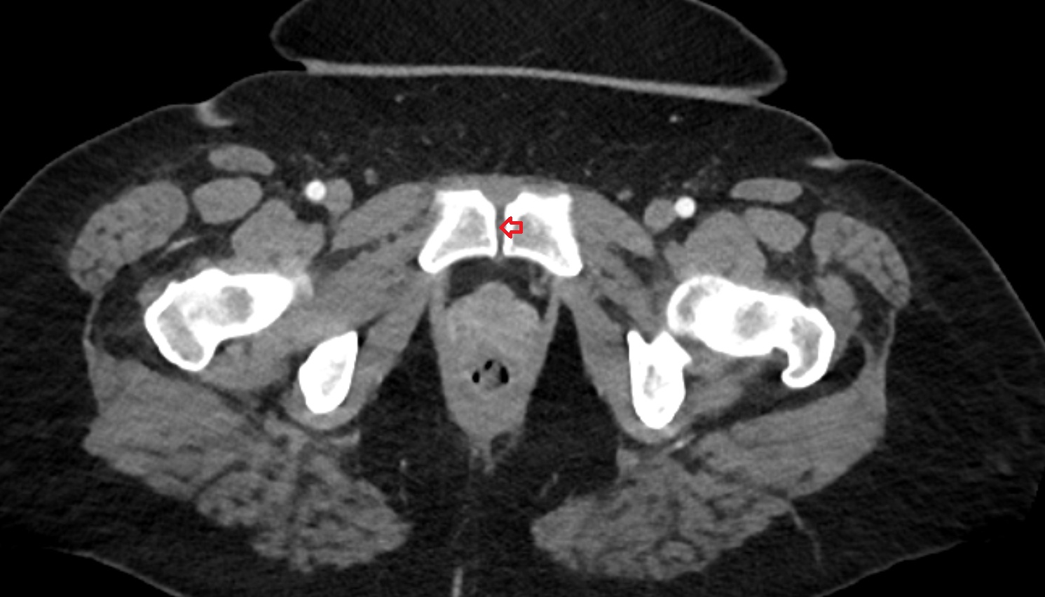 Pubic symphysis ct axial image  MRI coronal  anatomy  image-img-00000-00000