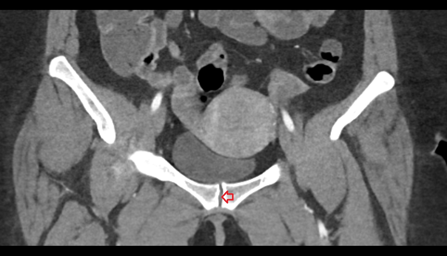 Pubic symphysis ct coronal image  MRI coronal  anatomy  image-img-00000-00000