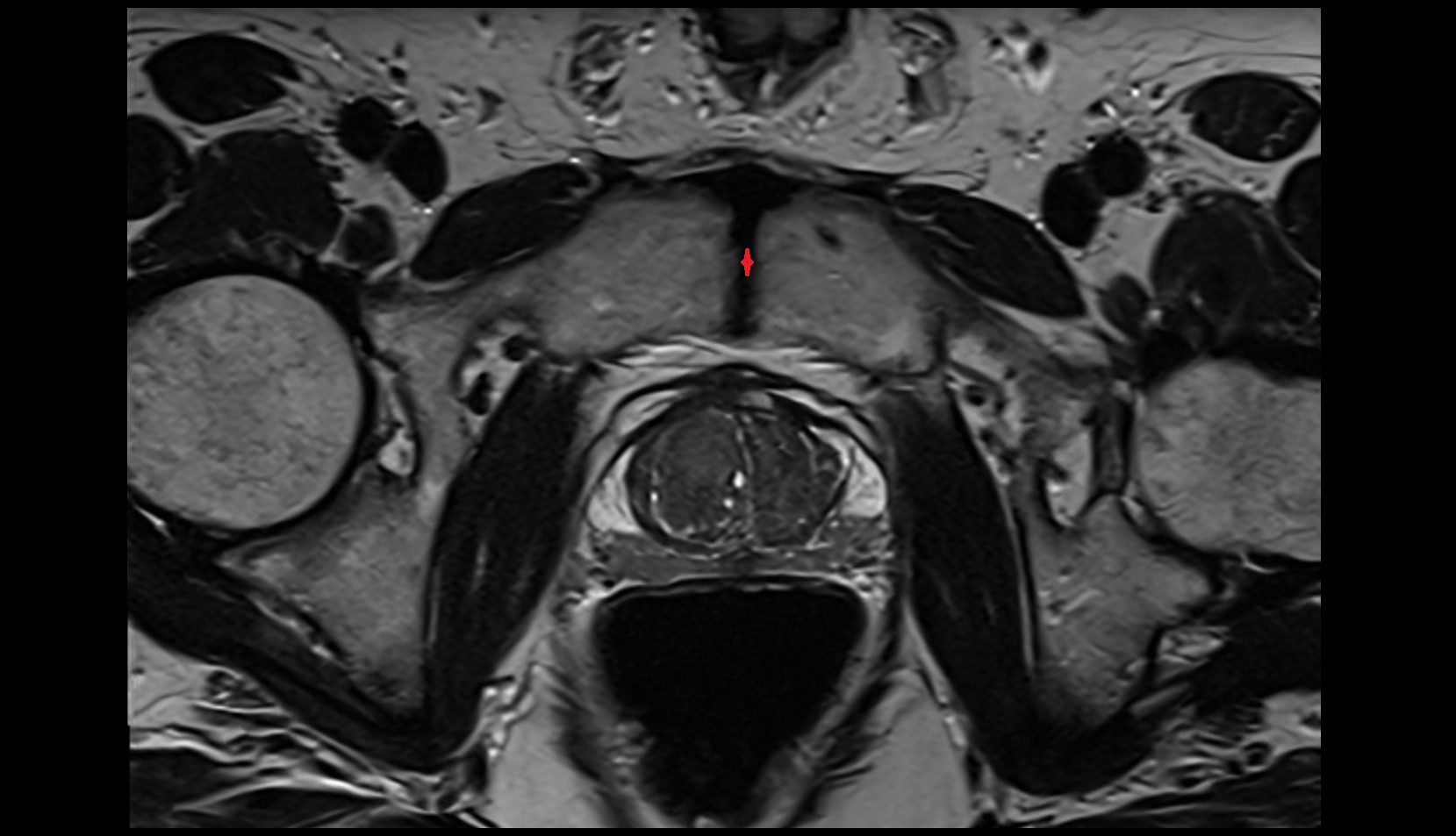 Pubic symphysis mri axial image