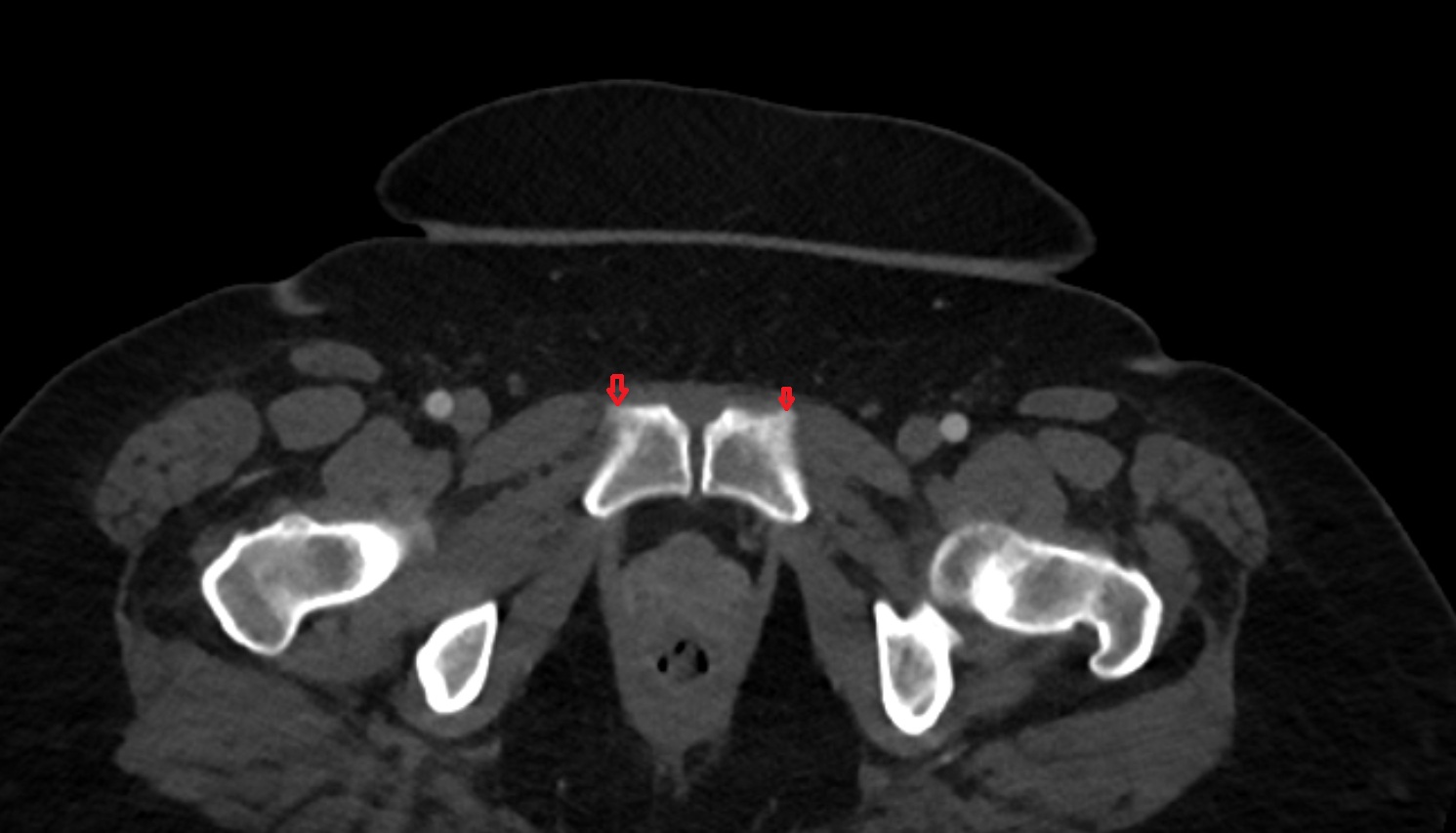 Pubic tubercle  CT axial  anatomy  image-img-00000-00000