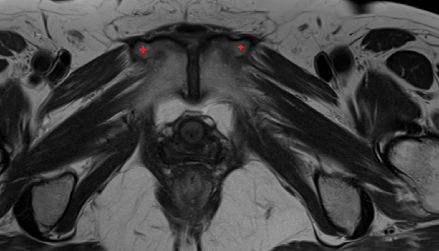 Pubic tubercle  mri  axial  anatomy  image-img-00000-00000