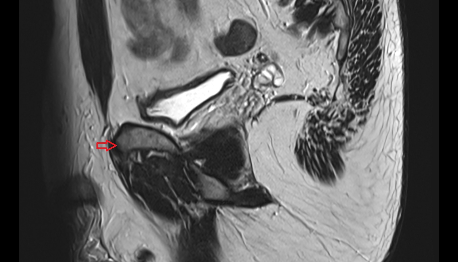 Pubic tubercle  mri sag  anatomy  image-img-00000-00000