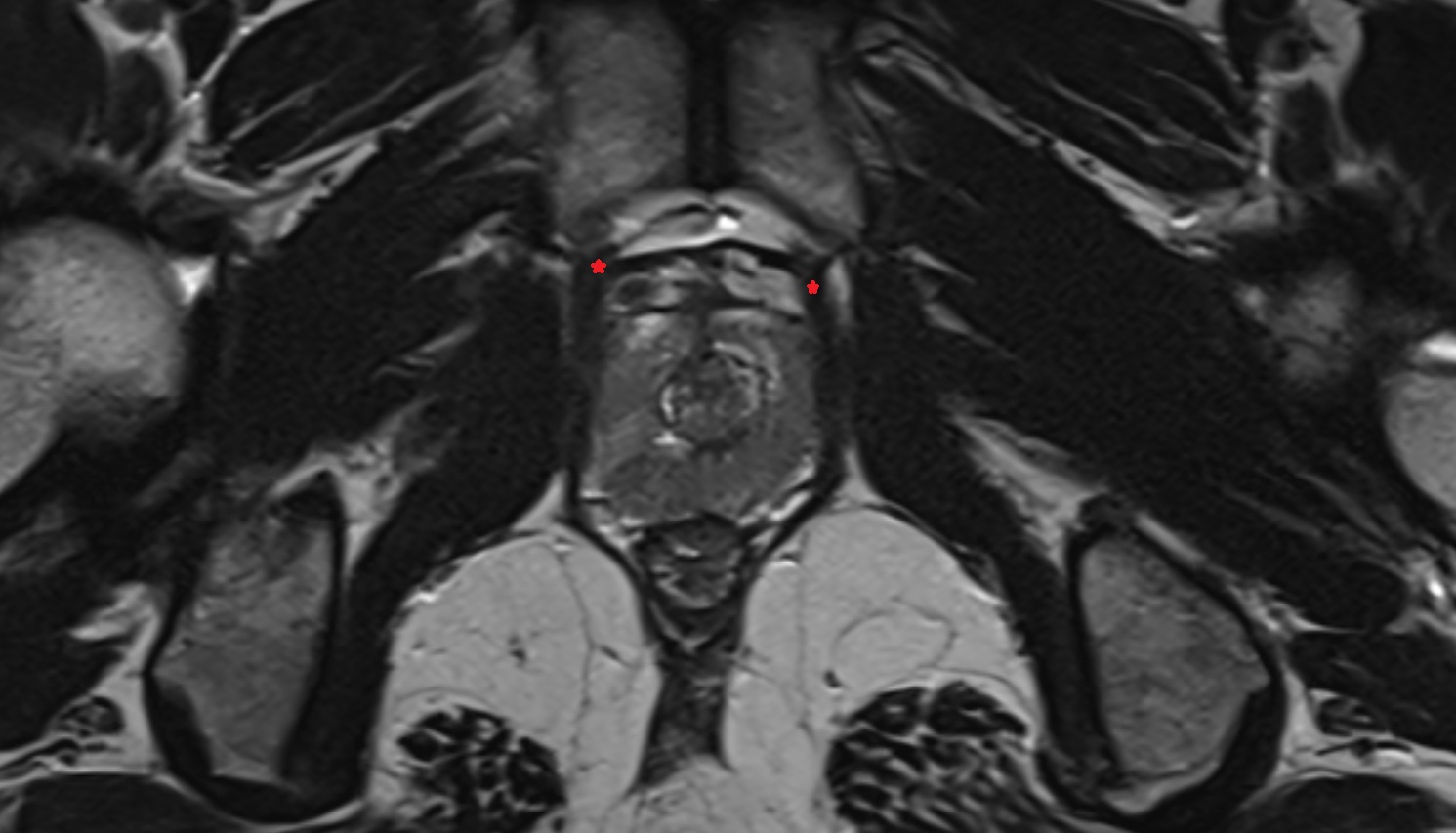 Puboanalis muscle  MRI  axial  anatomy  image-img-00000-00000