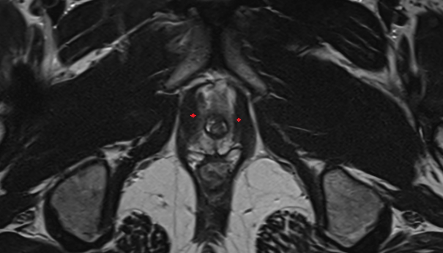 Puboanalis muscle  MRI  axial  anatomy  image-img-00000-00000_00001