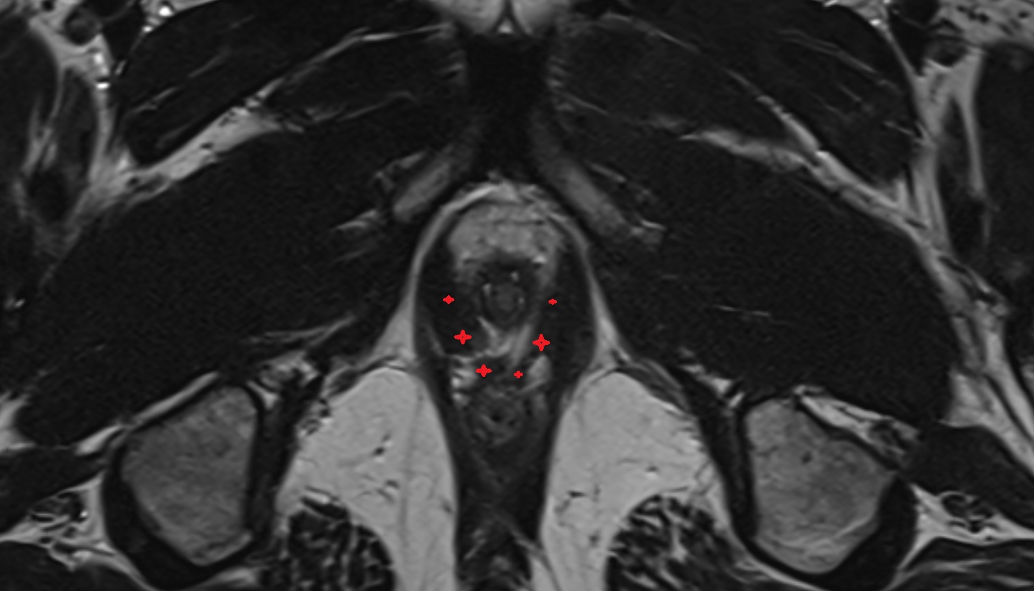 Puboanalis muscle  MRI  axial  anatomy  image-img-00000-00000_00002