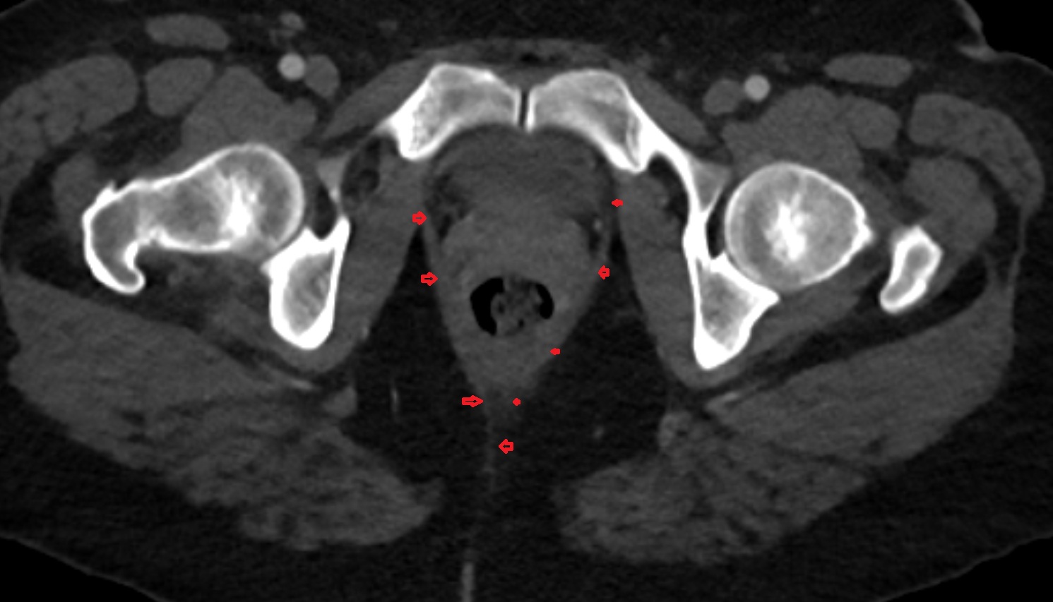 Pubococcygeus muscle  CT  axial  anatomy  image-img-00000-00000