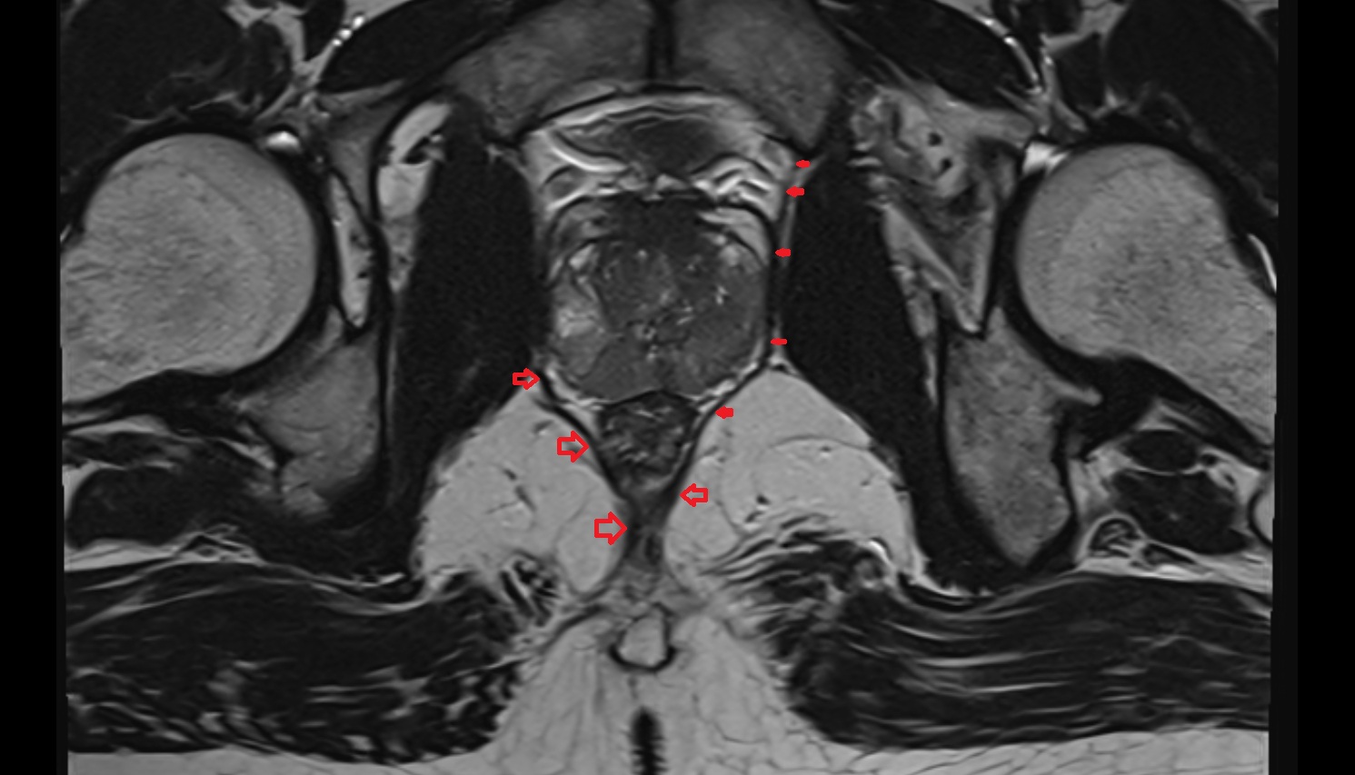 Pubococcygeus muscle  MRI  axial  anatomy  image-img-00000-00000