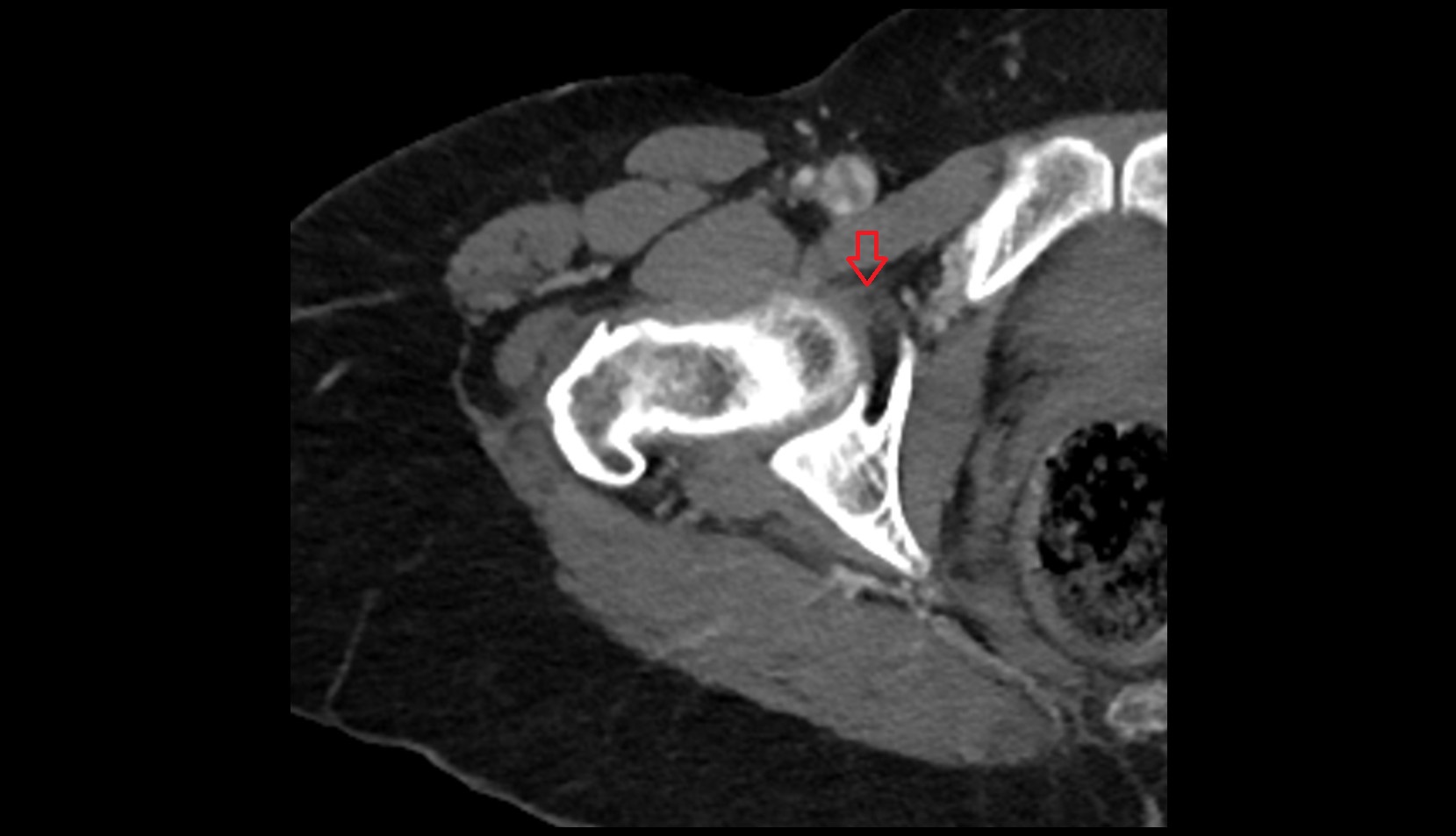Pubofemoral Ligament ct axial image