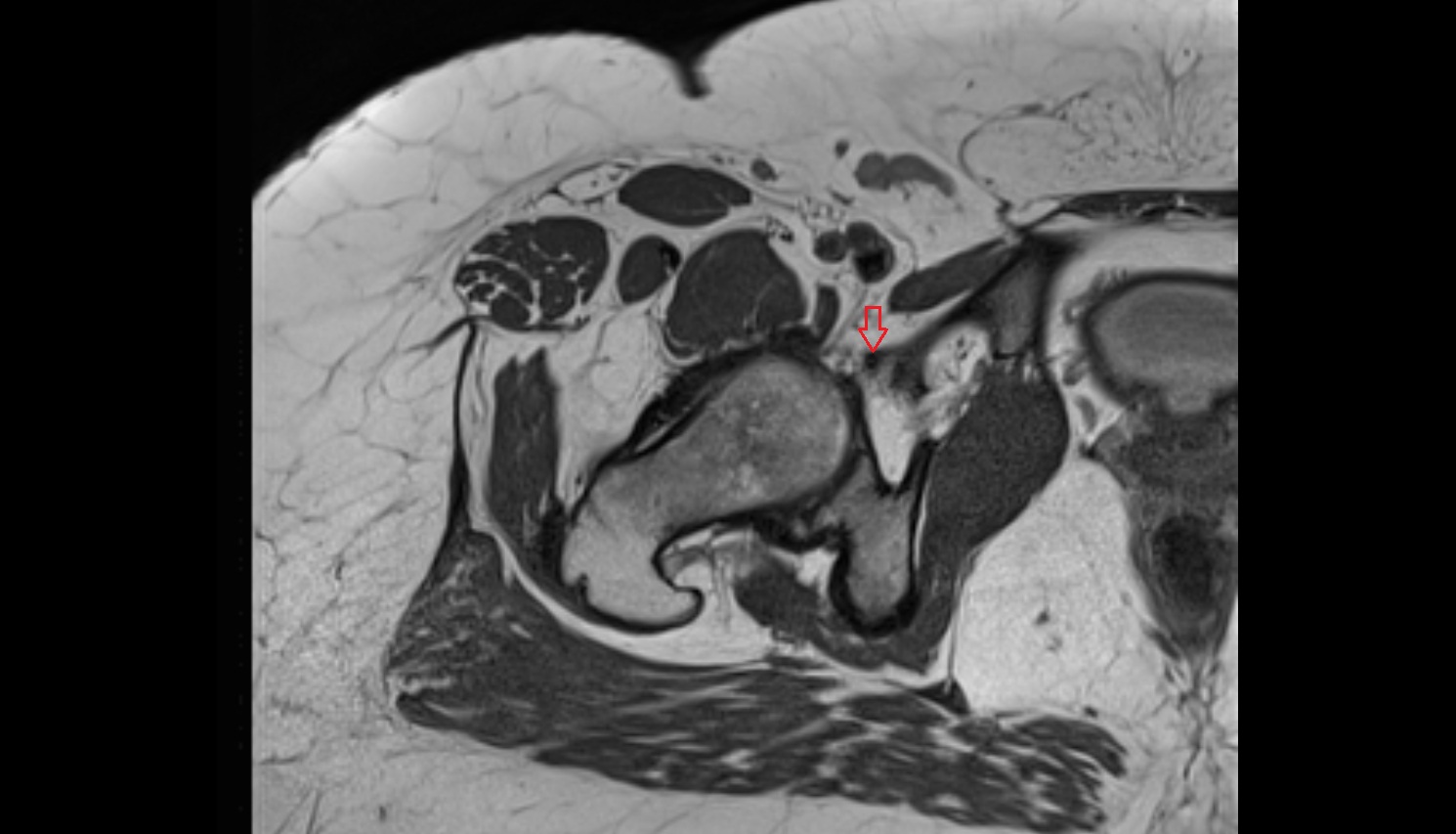 Pubofemoral ligament  MRI axial  anatomy image-img-00000-00000_00001