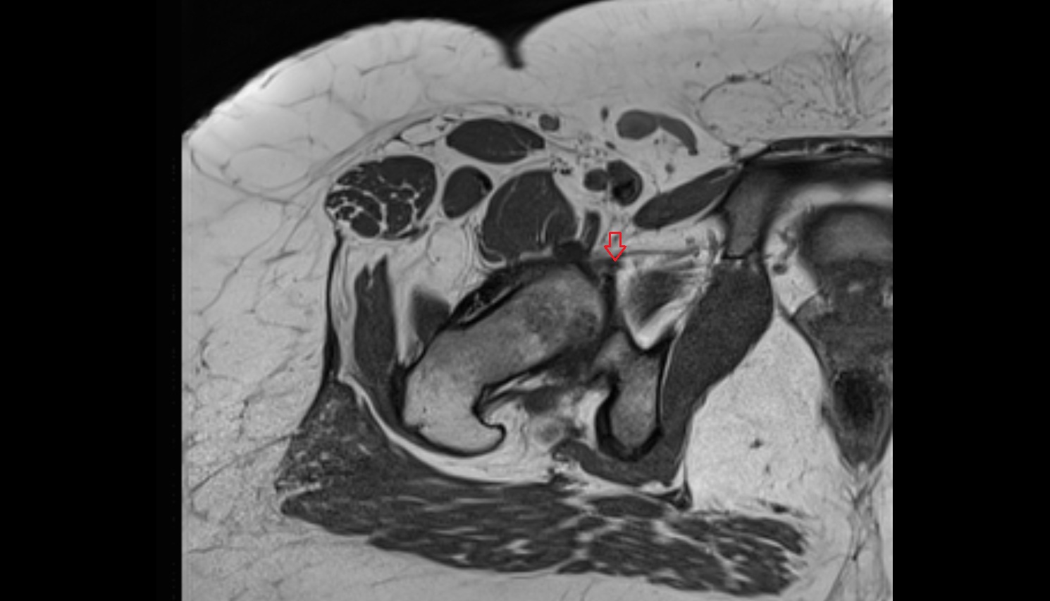 Pubofemoral ligament  MRI axial  anatomy image-img-00000-00000_00002