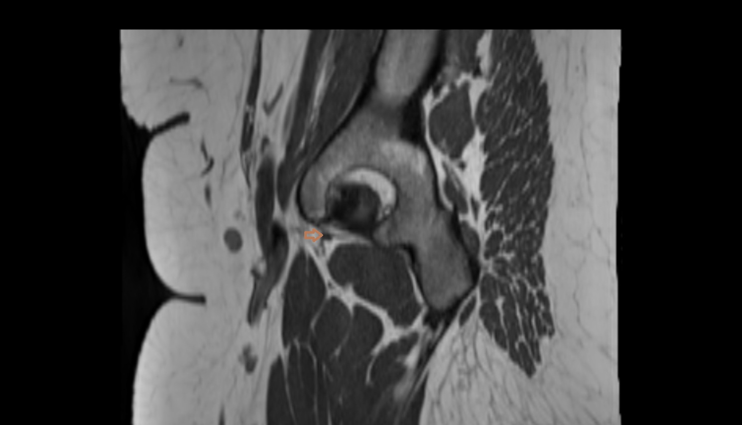 Pubofemoral ligament  MRI sagl  anatomy image-img-00000-00000_00001