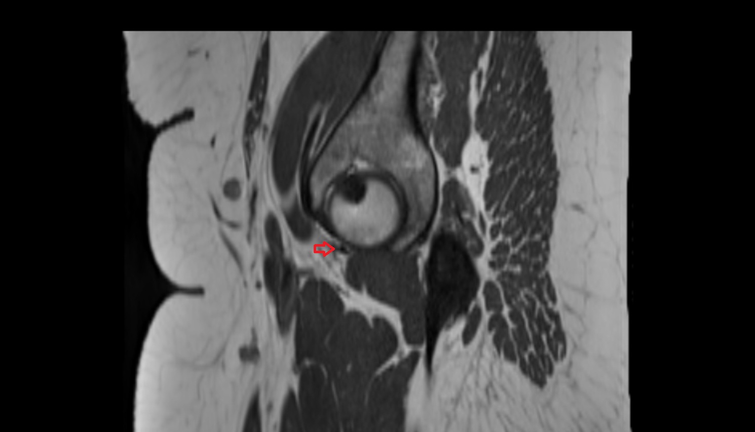 Pubofemoral ligament  MRI sagl  anatomy image-img-00000-00000_00002