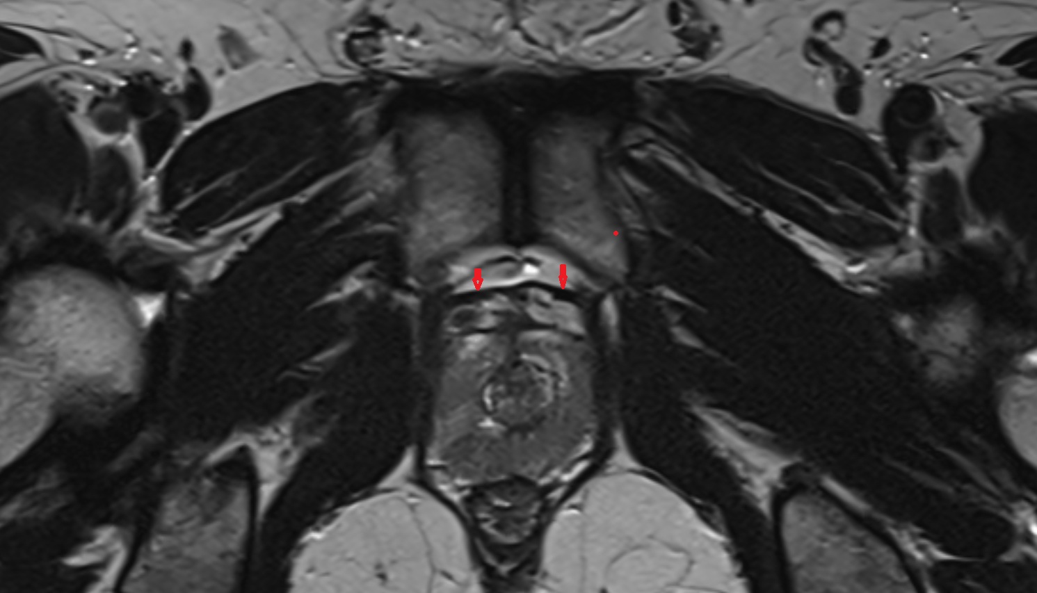Puboprostatic ligament   MRI  axial  anatomy  image-img-00000-00000