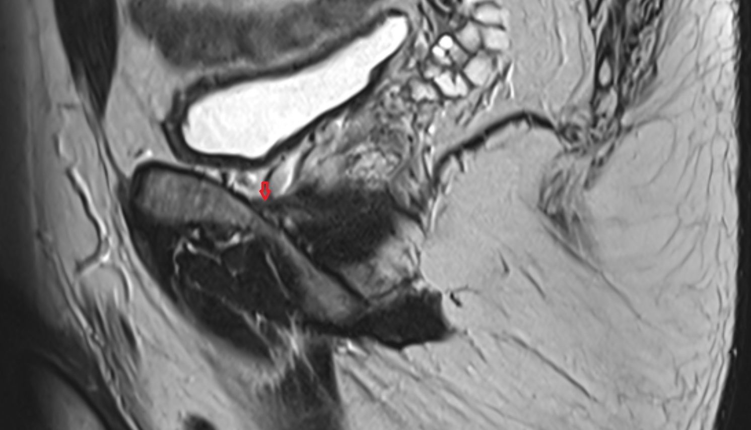 Puboprostatic ligament   MRI  sag  anatomy  image-img-00000-00000