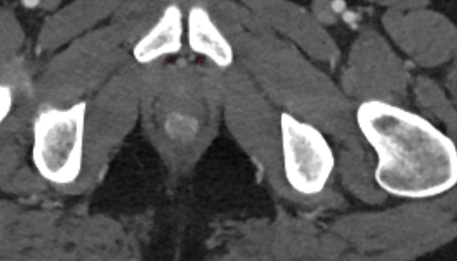 Puboprostatic ligament  ct axial  anatomy  image-img-00000-00000