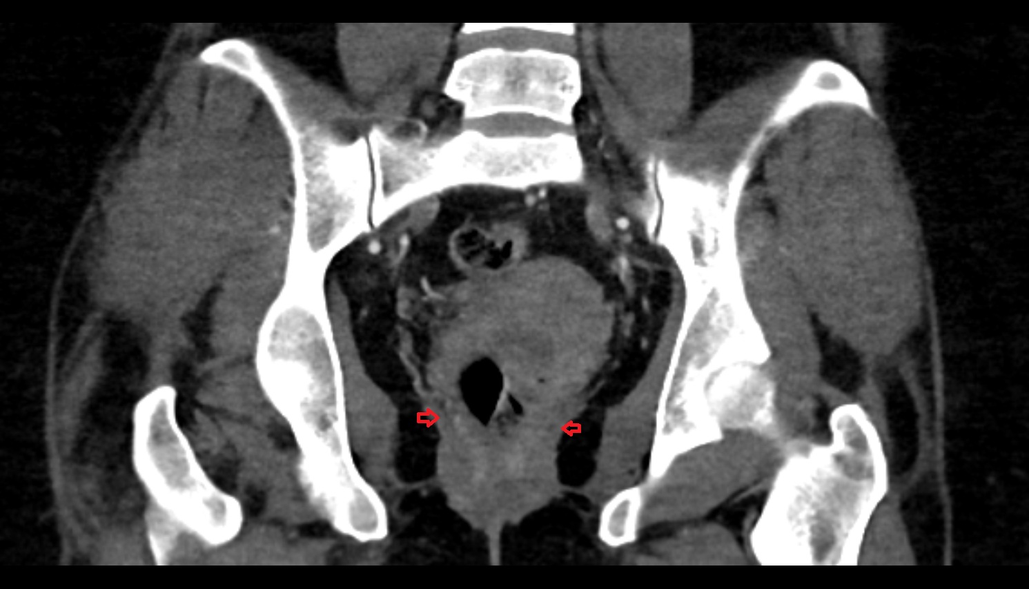 Puborectalis muscle CT  CORONAL  anatomy  image-img-00000-00000