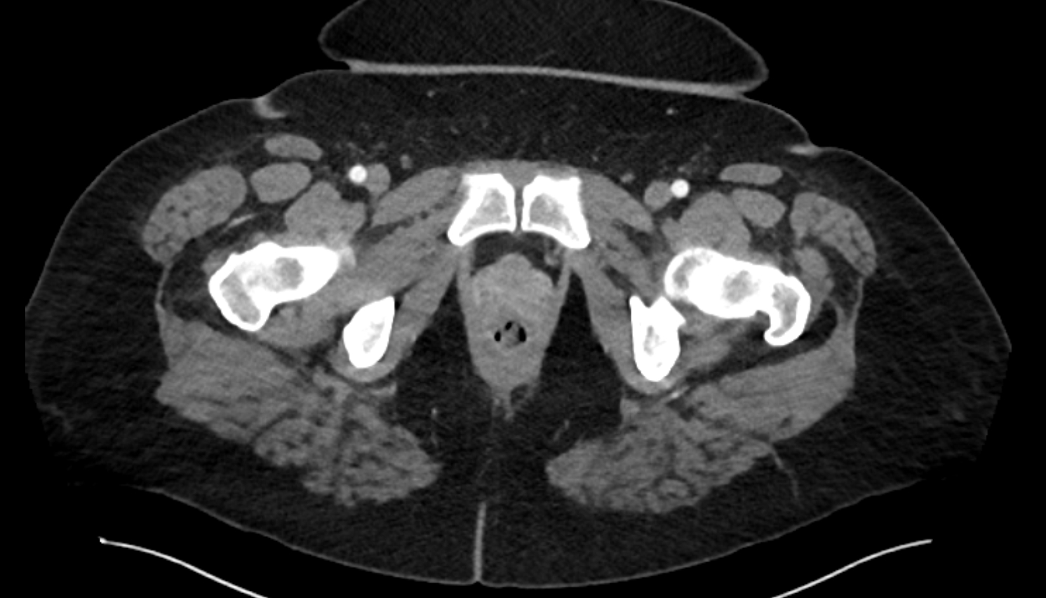Puborectalis muscle CT  axial  anatomy  image-img-00000-00000