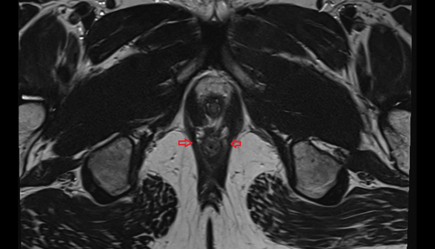 Puborectalis muscle MRI  axial  anatomy  image-img-00000-00000