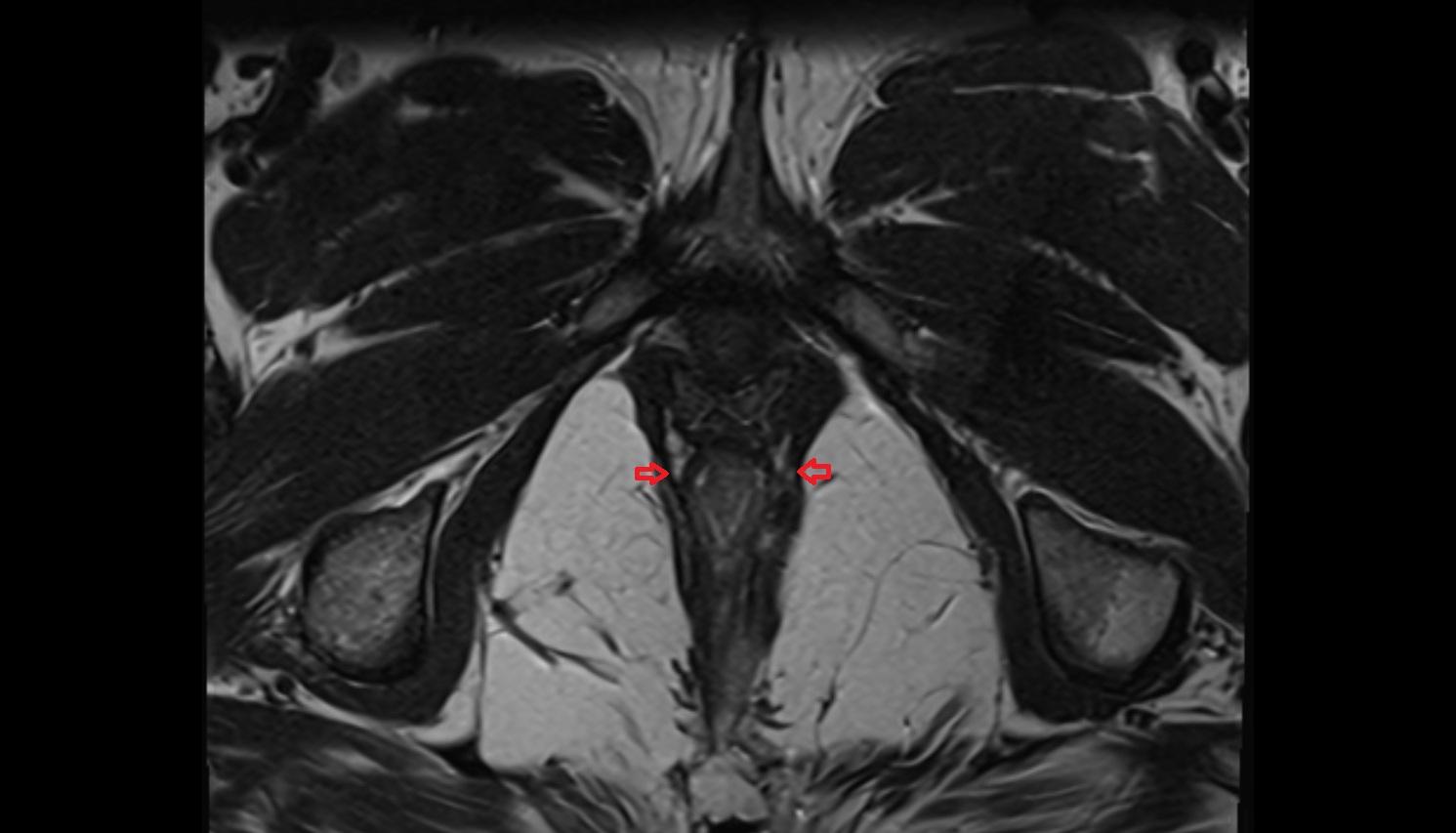 Puborectalis muscle MRI  axial  anatomy  image-img-00000-00000_00001